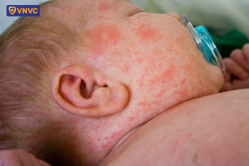 hình ảnh bệnh sởi ở trẻ ngày đầu tiên